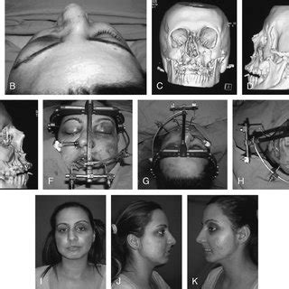 A Preoperative Anterior View Of The Patient B Preoperative Top View