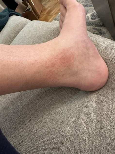 Itchy Raised Rash On Ankle R Dermatologyquestions