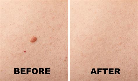 Mole Removal Healing Time Scarring And Aftercare Sandia Cosmetic