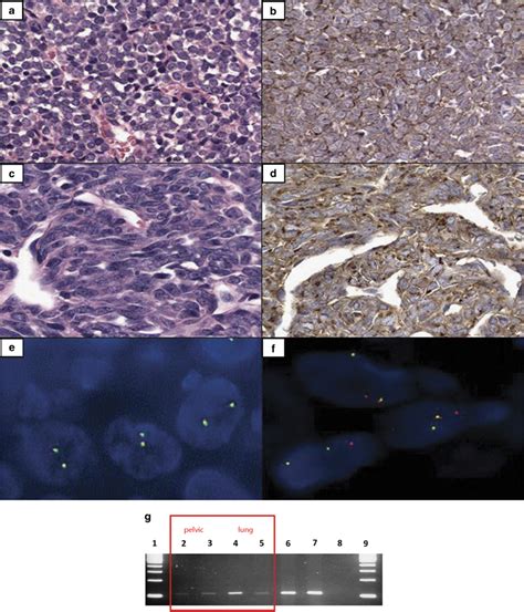 Poorly Differentiated Synovial Sarcoma Arising In The Pelvis With A