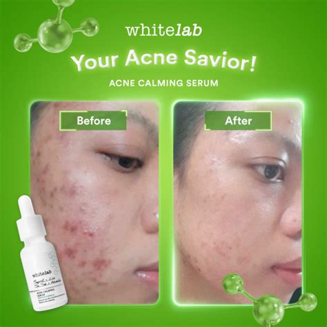 Whitelab Acne Calming Serum