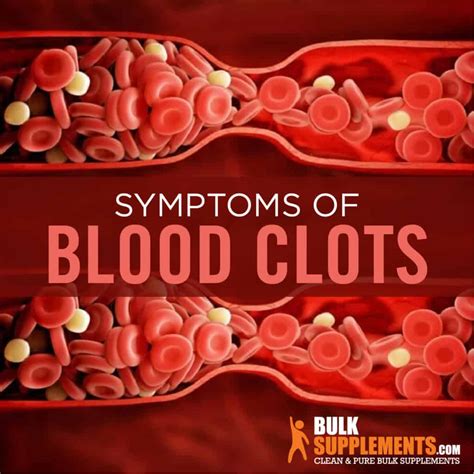 Blood Clots Symptoms, Causes and Treatment