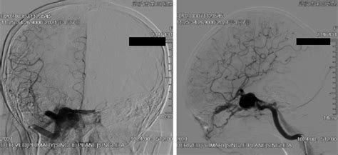 Figure 2 From Endovascular Treatment Of Direct Carotid Cavernous Fistula Resulting From Rupture