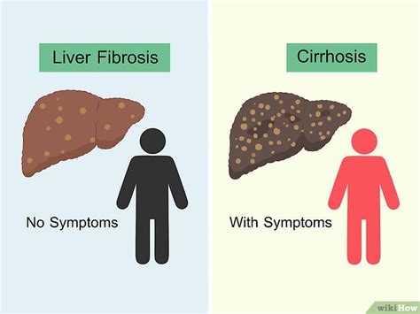 6 formas de tratar la fibrosis hepática wikiHow