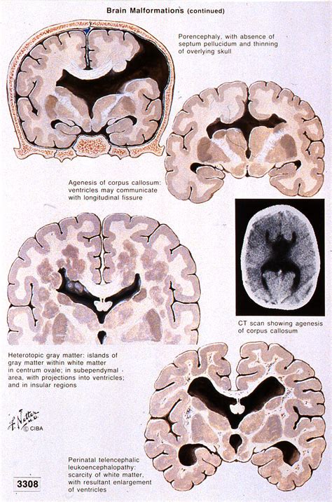 neuropathology blog: Brain Malformations