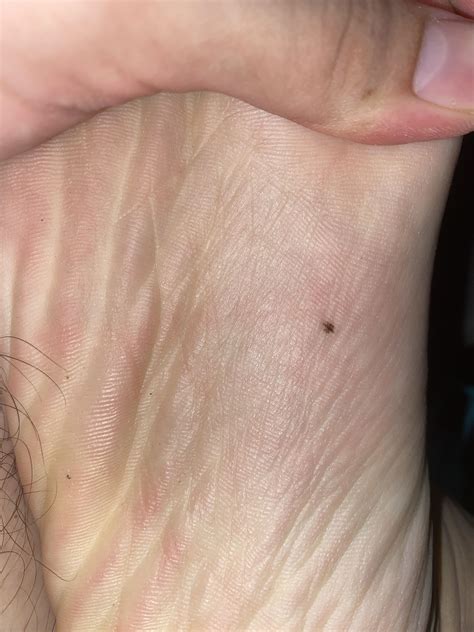 Melanoma Mole On Sole Of Foot Sale Emergencydentistry