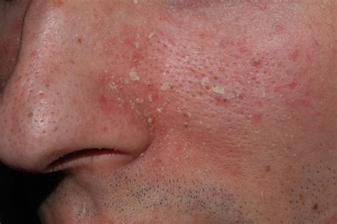 Dermatitis Seborreica Facial Dermatopharm