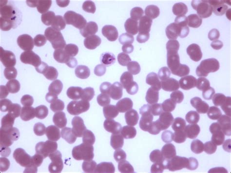 Plasmodium Vivax