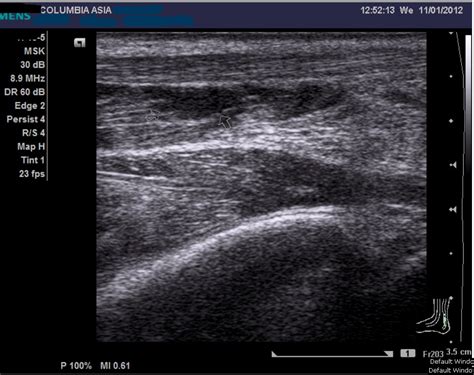 Gastrocnemius Muscle Tear (Calf Tear) | The Orthopedics Malaysia blog