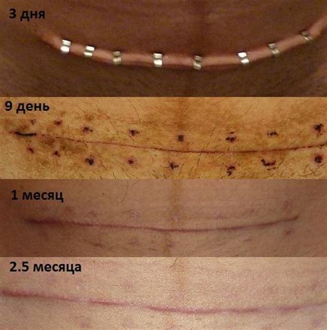 Швы саморассасывающиеся и синтетические, внутренние и внешние: как ...