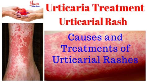 Urticaria Rash Causes