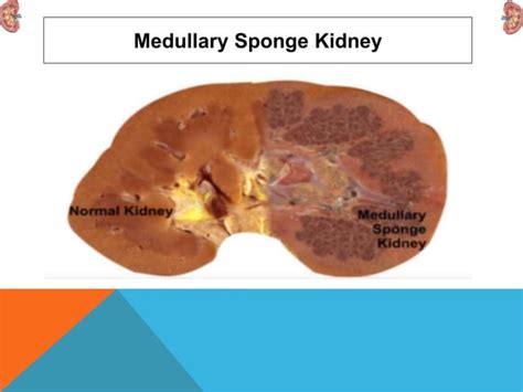 Medullary sponge kidney (msk) | PPT