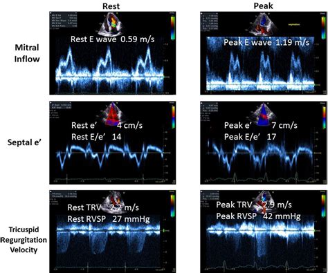 Diastolic Stress Echocardiography From Basic Principles To Clinical