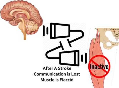 How To Treat Spasticity Orlando Neuro Therapy