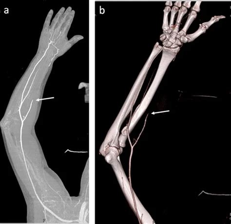 Mri Angiography Upper Limb Test Price In Delhi Ganesh Diagnostic