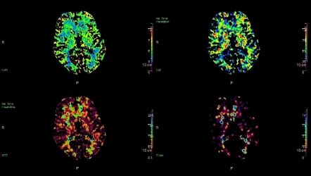 Subdural hemorrhage on CT perfusion | Radiology Case | Radiopaedia.org