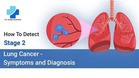 How To Detect Stage 2 Lung Cancer - Symptoms and Diagnosis