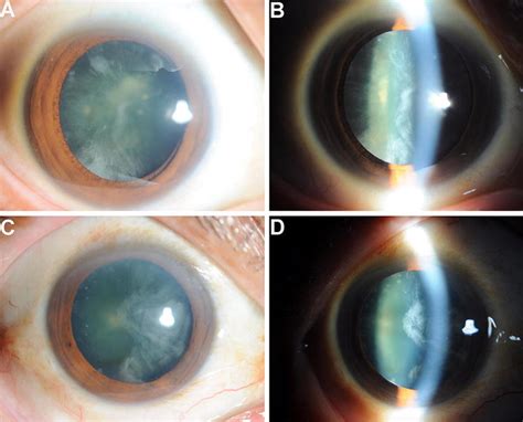 Cortical Cataract