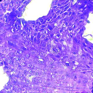 Well Differentiated Squamous Cells Carcinoma Of Esophagus H E X40