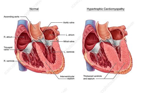 Hypertrophic Cardiomyopathy Stock Image C036 5332 Science Photo