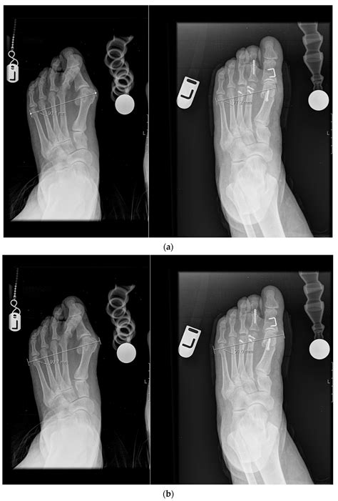 Jcm Free Full Text Hallux Valgus Repair With Chevron Osteotomy Significantly Narrows