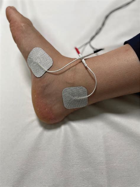 Efficacy Of Transcutaneous Tibial Nerve Stimulation In The T