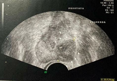 Ultrassonografia De Próstata Download Scientific Diagram