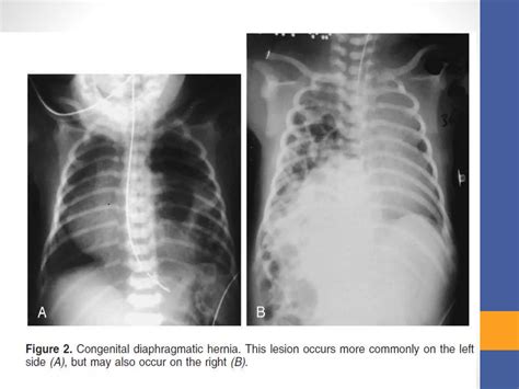 Anaesthetic Management Of Tracheoesophageal Fistula And Congenital