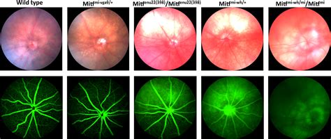 rpe mutations lead  retinal hypopigmentation vasculature