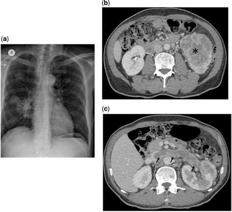 (a) Cannon ball metastasis in chest X ray, (b) Renal cell carcinoma in ...