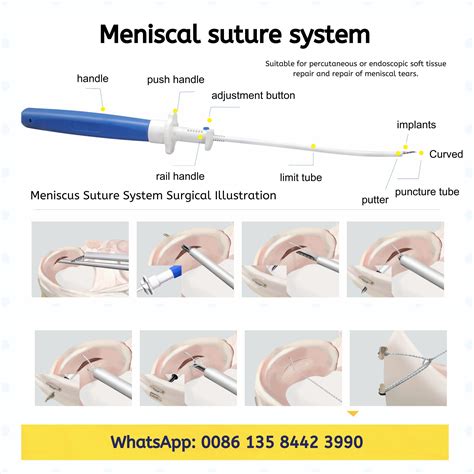 our suture-based meniscus repair... - Orthopedic implants | Facebook