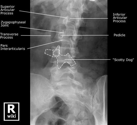 Lumbar Spine Anatomy Xray