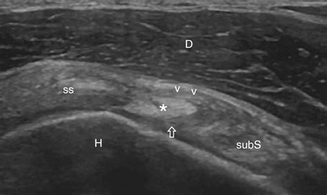 Rotator Cuff Ultrasound Images