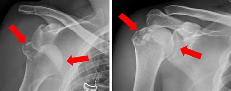 Shoulder Dislocation With Fracture Shoulder Dislocation With Broken