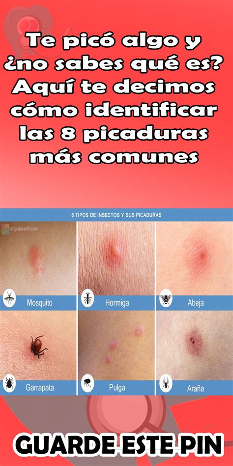 Tipos De Picaduras De Insectos