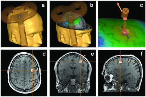 Tms Targeted Region Neuronavigation And Coil Placement The Specific