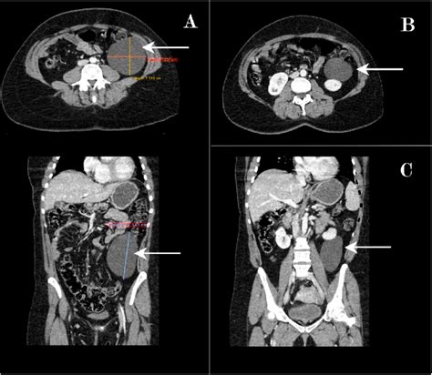 Large Retroperitoneal Cystic Mass Axial And Coronal View Of Abdominal