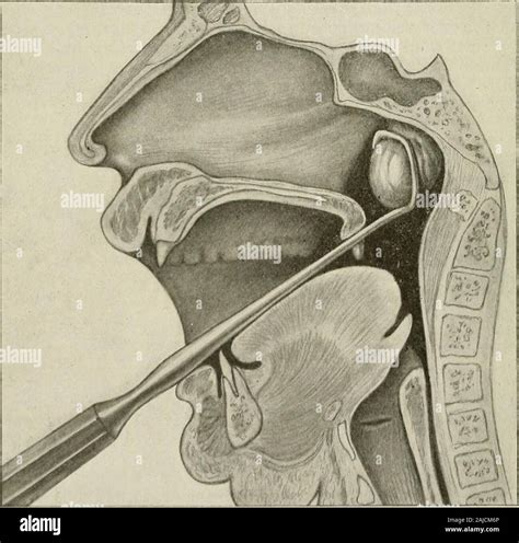 Adenoid Removal Hi Res Stock Photography And Images Alamy