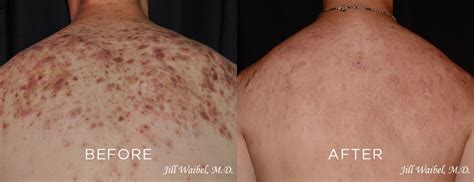 Acne Scars — Miami Dermatology & Laser Institute