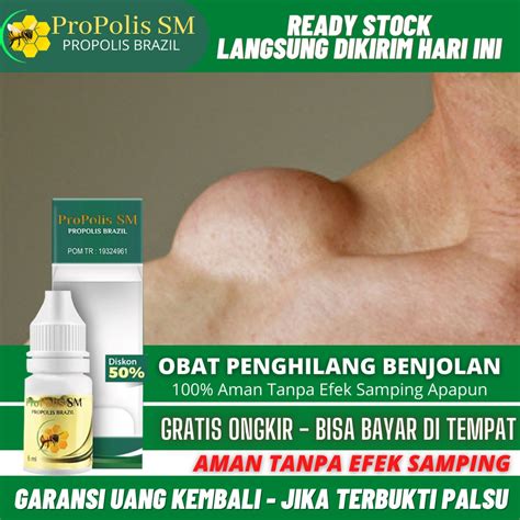 Jual Obat Penghilang Benjolan Di Tubuh Benjolan Lipoma Uci Uci