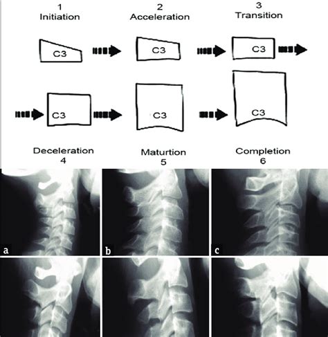 Cervical Vertebrae Maturation Indicators Given By Brent Hassel And