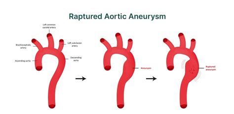 Understanding Aortic Aneurysm: Symptoms, Causes & Treatments