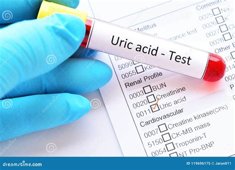 Como É Feito O Exame De Ácido Úrico - Tubo Da Amostra De Sangue Para O Teste ácido úrico Imagem de Stock ...