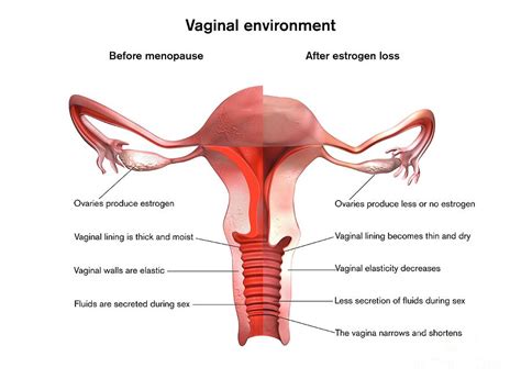 Menopause Vaginal Effects Photograph By Gunilla Elam Science Photo