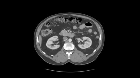 Abdominal CT scan | PPT