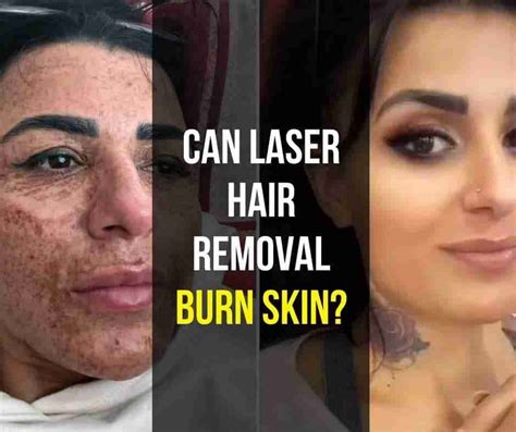 Can laser hair removal burn skin? | by GGreat | Mar, 2024 | Medium