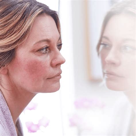 Rosacea Facial Redness That Wont Go Away Heres A Treatment That Can Help