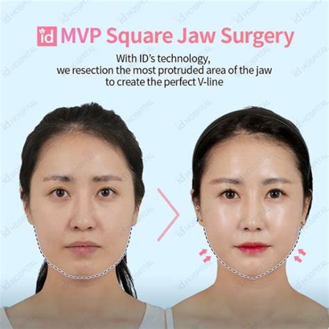 Square Jaw V Line Surgery Facial Contouring Jaw Reduction Surgery V