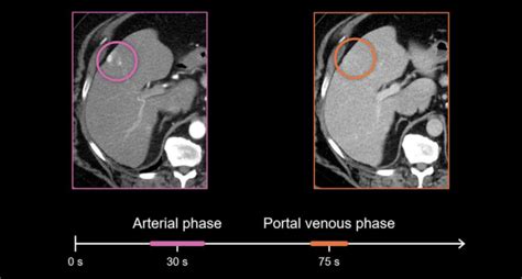 Abdominal CT: Cancer staging • LITFL • Radiology library