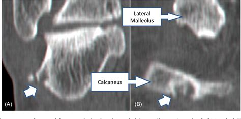 Peroneal Tubercle Of Calcaneus